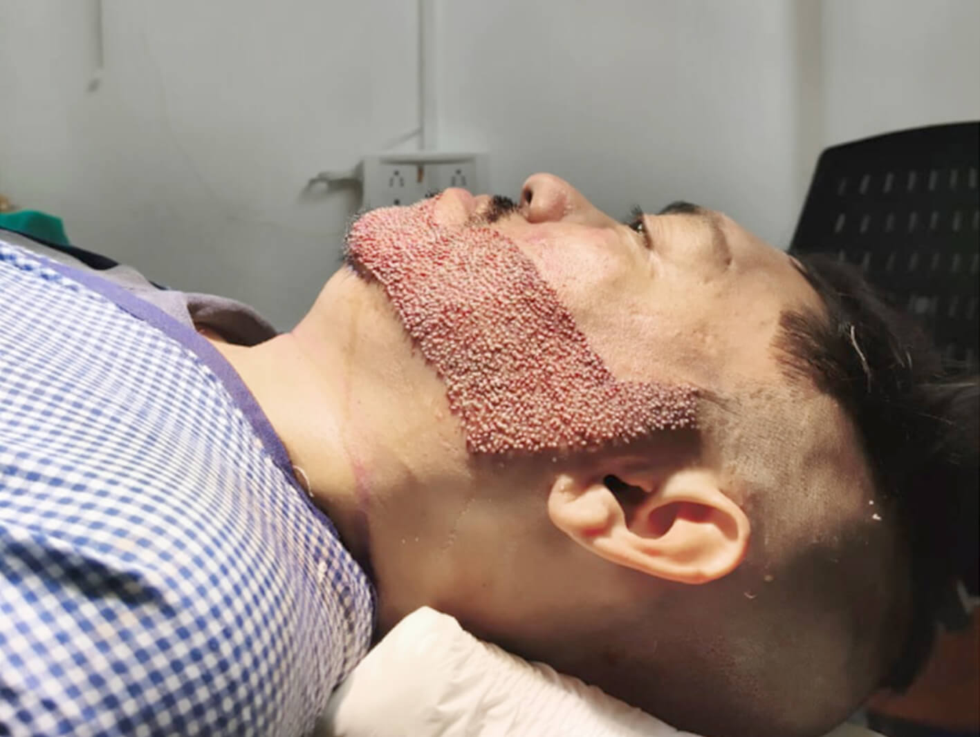 Natural beard transplant procedure